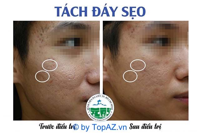 Giải pháp trị sẹo rỗ chuyên sâu tại Bệnh viện Da liễu TP.HCM