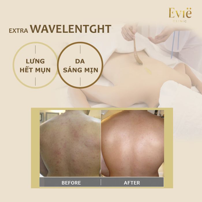 Quy trình điều trị mụn lưng chuẩn y khoa tại Evie Clinic