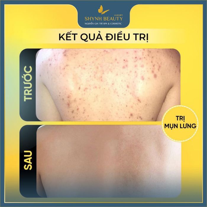 Shynh Beauty Spa Nguyễn Gia Trí ảnh 2 - Góc nhìn chân thực về quy trình chăm sóc da chuyên nghiệp, nơi mỗi bước điều trị đều được thực hiện tỉ mỉ