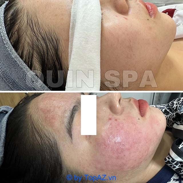 Địa chỉ vàng về trị mụn và chăm sóc sắc đẹp tại Bến Tre
