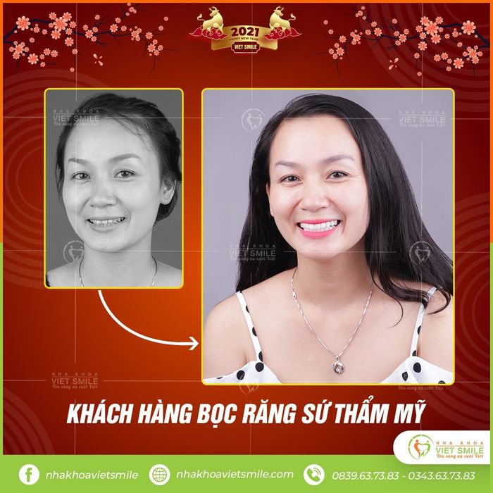 VIET SMILE - Viện Thiết Kế Nụ Cười 4.0 ảnh 1 - Hình ảnh chân thực về quy trình chăm sóc răng miệng đạt chuẩn quốc tế
