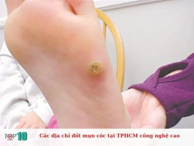 Những địa chỉ đốt mụn cóc công nghệ cao tại TP.HCM