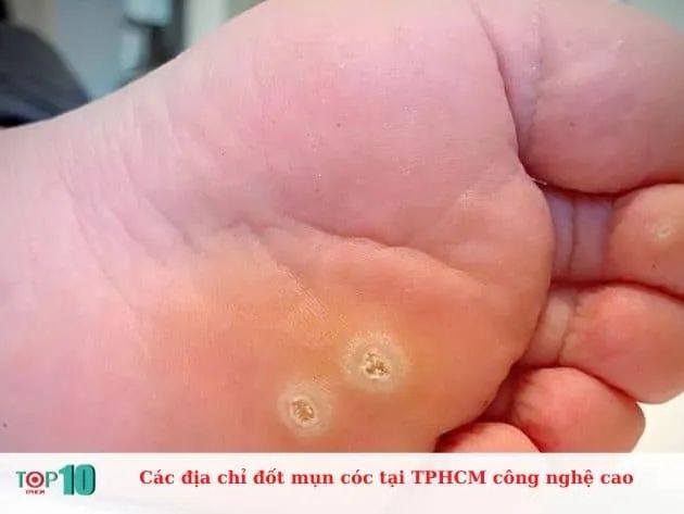 Các địa chỉ đốt mụn cóc tại TPHCM công nghệ cao