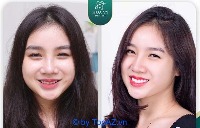 Bọc răng sứ Hải Phòng - Đẳng cấp quốc tế, giá trị Việt