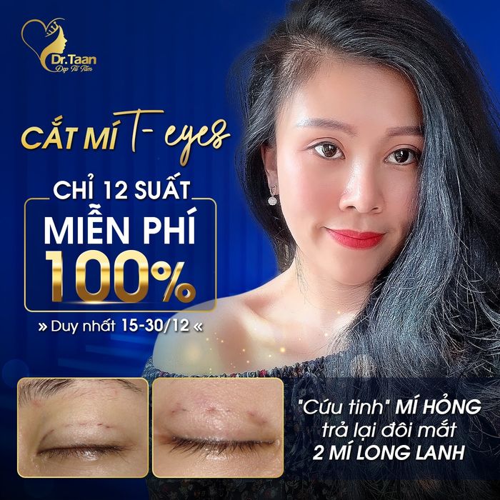 Hình ảnh quy trình sửa mí hỏng chuẩn y khoa tại Viện Thẩm Mỹ Dr Taan