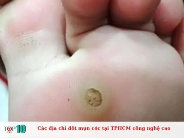 Các địa chỉ đốt mụn cóc tại TP.HCM ứng dụng công nghệ hiện đại hàng đầu