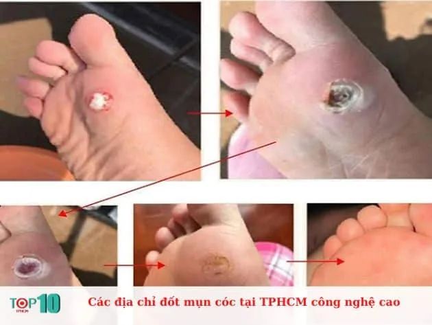 Các địa chỉ đốt mụn cóc tại TPHCM công nghệ cao
