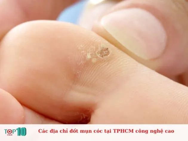 Các địa chỉ đốt mụn cóc tại TPHCM công nghệ cao