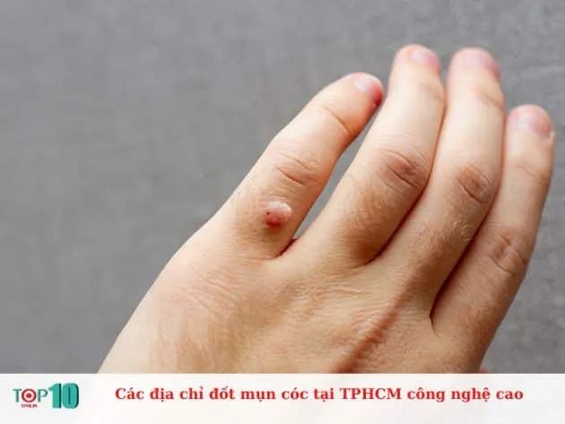 Các địa chỉ đốt mụn cóc tại TP.HCM ứng dụng công nghệ cao tiên tiến