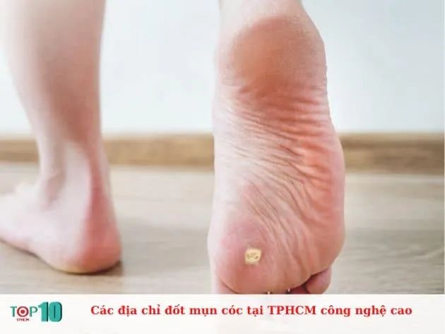 Danh sách các địa chỉ đốt mụn cóc ứng dụng công nghệ hiện đại tại TP.HCM