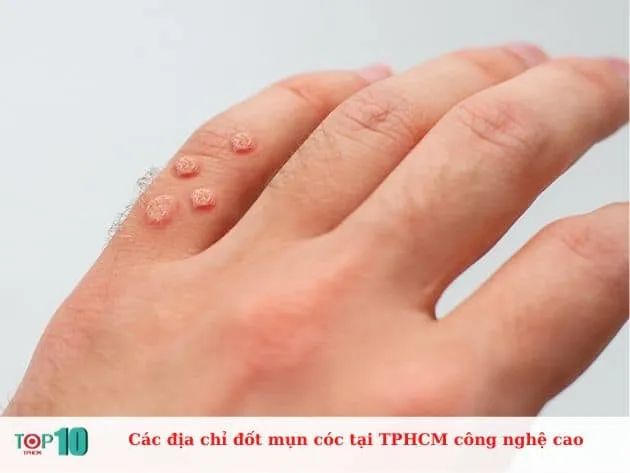 Các địa chỉ đốt mụn cóc tại TPHCM công nghệ cao