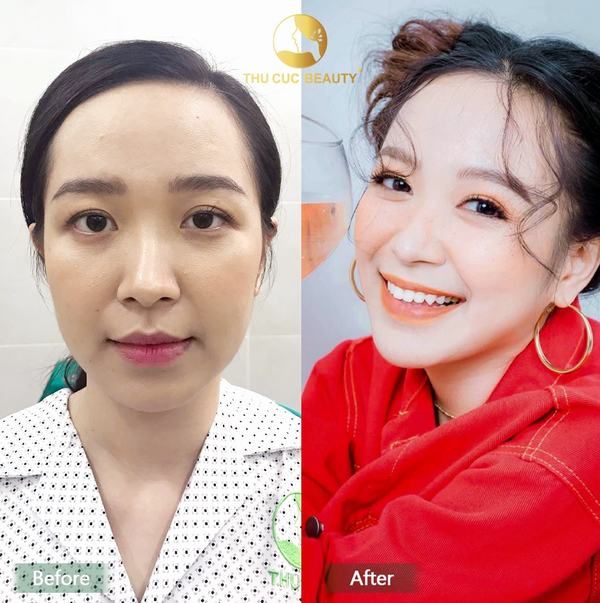Hình ảnh thực tế về quy trình sửa mí hỏng tại Bệnh viện Thẩm mỹ Thu Cúc