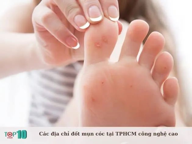 Các địa chỉ đốt mụn cóc tại TPHCM ứng dụng công nghệ tiên tiến