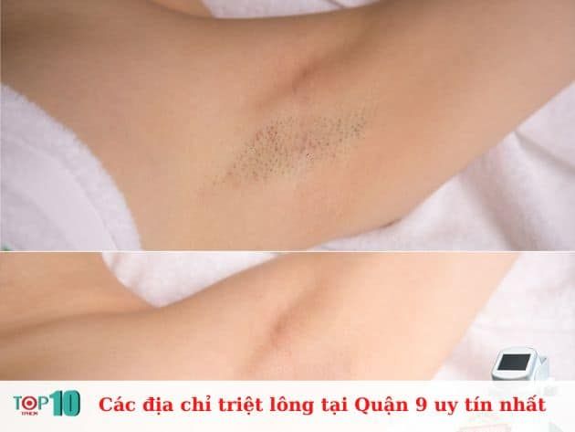 Danh sách các địa chỉ triệt lông uy tín tại Quận 9