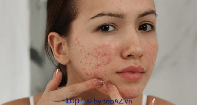 Trị mụn và làm đẹp da chuyên nghiệp tại các spa hàng đầu Quận Thanh Khê, Đà Nẵng