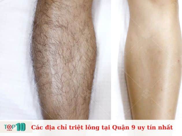 Danh sách các địa chỉ triệt lông uy tín tại Quận 9