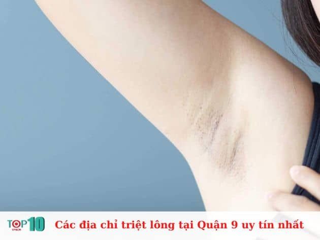 Danh sách các địa chỉ triệt lông uy tín tại Quận 9