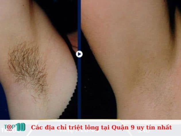 Danh sách các địa chỉ triệt lông uy tín tại Quận 9