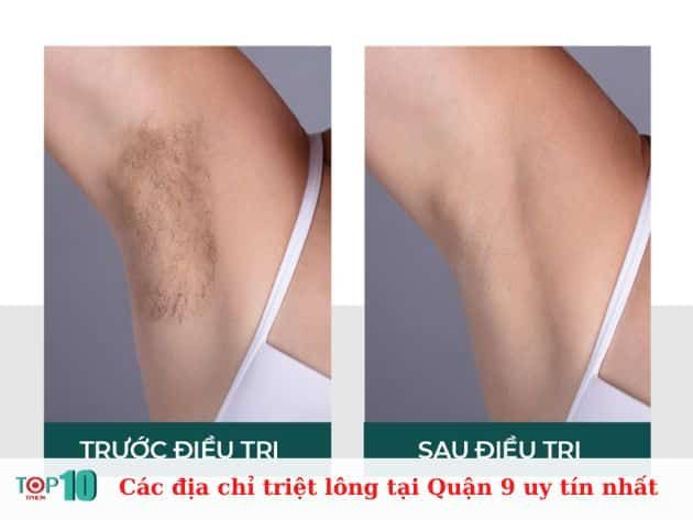 Danh sách các địa chỉ triệt lông uy tín tại Quận 9