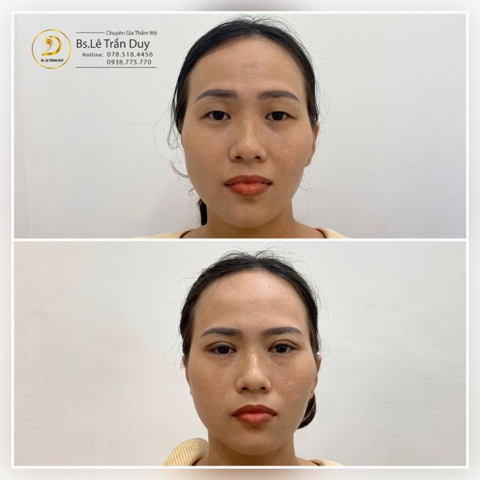 địa chỉ cắt mí mắt uy tín TPHCM