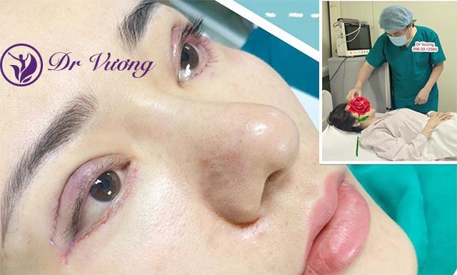 Cắt mí mắt tại TPHCM
