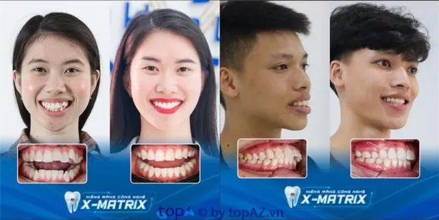Nha khoa Lạc Việt Intech tại Hải Phòng – địa chỉ uy tín trong niềng răng.