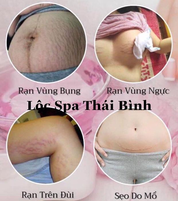 Hình ảnh trị liệu chuyên nghiệp tại Lộc Spa Thái Bình