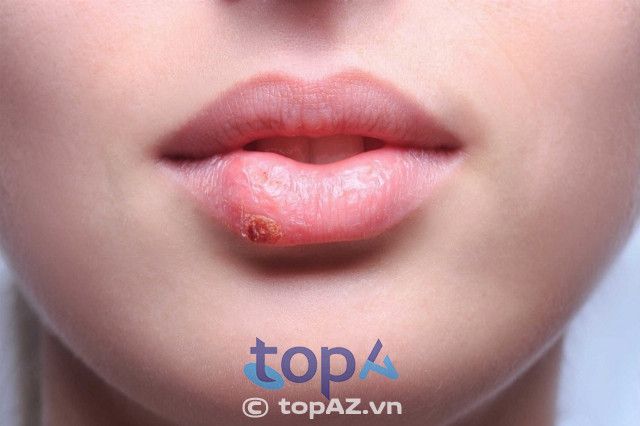 Hiện tượng sưng môi sau khi thực hiện tạo hình