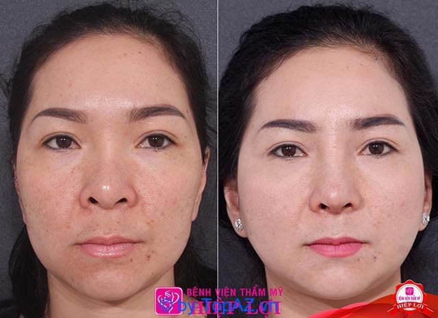 Địa chỉ cấy mỡ hốc mắt TP.HCM