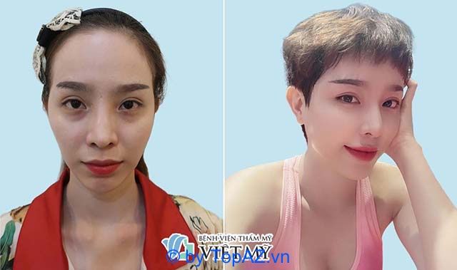 Cấy mỡ hốc mắt TP.HCM