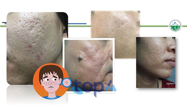 Bệnh viện Da liễu TP.HCM - Tiên phong trong điều trị sẹo thẩm mỹ