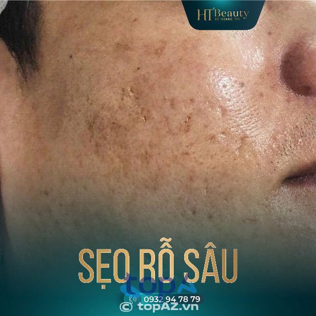 H&T Spa TP.HCM - Tiên phong trong điều trị sẹo chuyên sâu