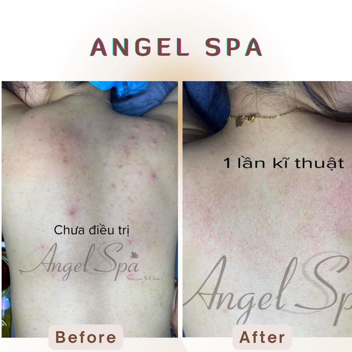 Hình ảnh trị liệu chuyên nghiệp tại Angel Spa