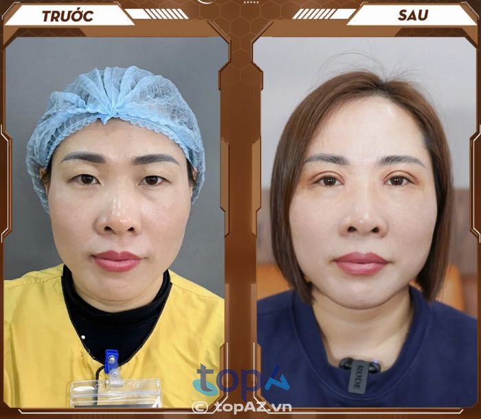 Cắt mí tại Dr. Hải Lê – Địa chỉ uy tín tại Hà Nội