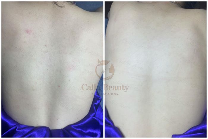 Hình ảnh quy trình điều trị chuyên nghiệp tại Calla Beauty