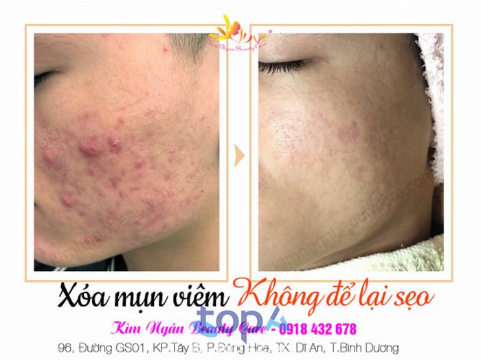spa trị mụn Bình Dương