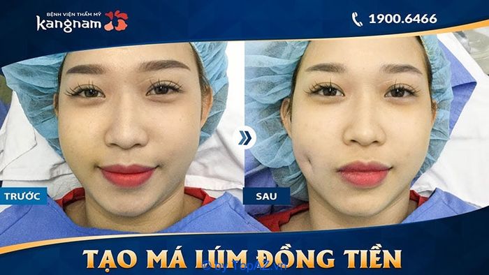 địa chỉ tạo má lúm đồng tiền uy tín tại TPHCM