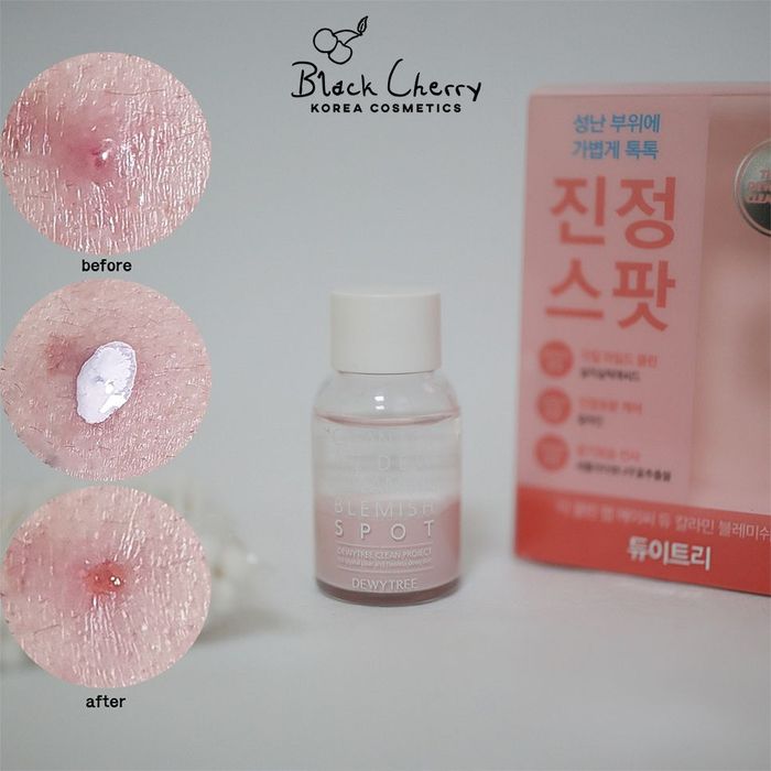Hình ảnh thực tế tinh chất chấm mụn DewyTree AC DEW Calamine - Công thức đặc biệt cho da mụn