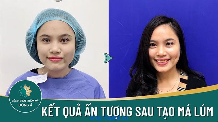 địa chỉ tạo má lúm đồng tiền uy tín tại TPHCM