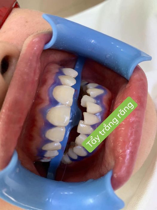 Ảnh minh họa: Nha Khoa Thẩm Mỹ Lào Cai - Ann Dental (ảnh 2)