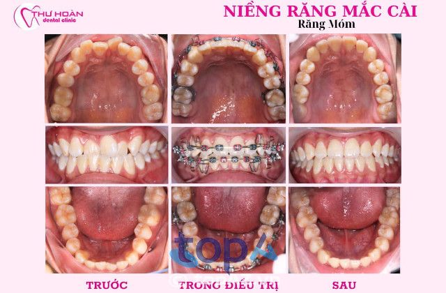 Địa chỉ niềng răng đẹp tại Quy Nhơn