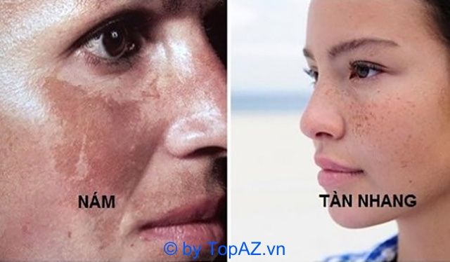 Dịch vụ trị nám và tàn nhang tại Bệnh viện Da liễu TPHCM