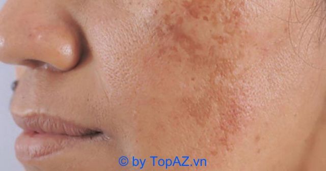 Dịch vụ điều trị nám và tàn nhang giá hợp lý tại Bệnh viện Da liễu TPHCM