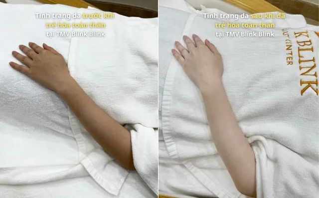 Công Nghệ Trẻ Hóa Da Độc Quyền Tại Blink Blink Beauty Center