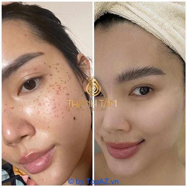 Địa chỉ spa trị nám uy tín hàng đầu tại Quận 9