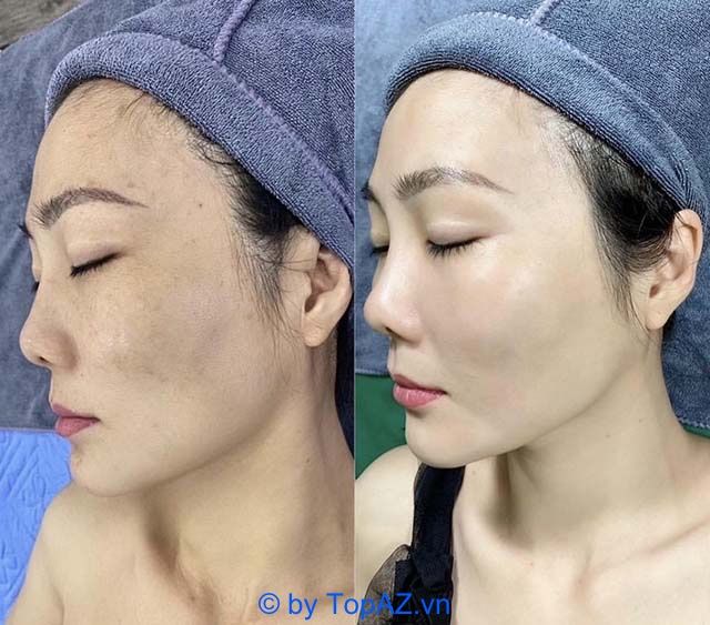 Địa chỉ spa trị nám uy tín bậc nhất tại Quận 9