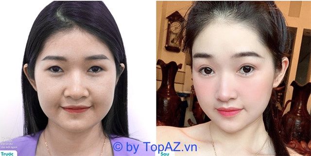 Hành trình thay đổi ấn tượng trước và sau khi cắt mí