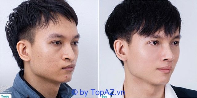 Hành trình tái tạo nhan sắc: Chỉnh hình mũi dị tật bằng công nghệ đỉnh cao tại JK Nhật Hàn