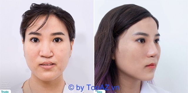 Hành trình tái tạo nét đẹp hoàn hảo: Chỉnh hình mũi cho các trường hợp sứt môi hở hàm ếch