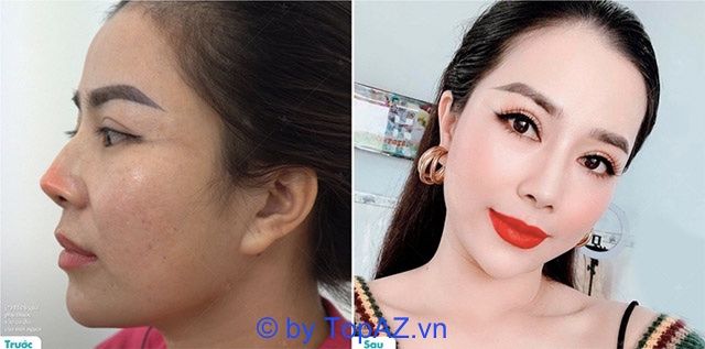 Hành trình tái tạo hoàn hảo: So sánh hình ảnh trước và sau khi chỉnh sửa mũi thẩm mỹ không thành công